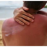Cara Meredakan Sun Burn Dan Cara Mencegahnya