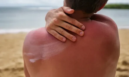 Cara Meredakan Sun Burn Dan Cara Mencegahnya