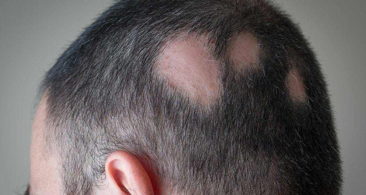 Pemicu Rambut Rontok, Ini Dia Yang Harus Kamu Pahami!