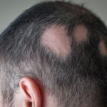 Pemicu Rambut Rontok, Ini Dia Yang Harus Kamu Pahami!