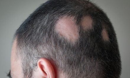 Pemicu Rambut Rontok, Ini Dia Yang Harus Kamu Pahami!