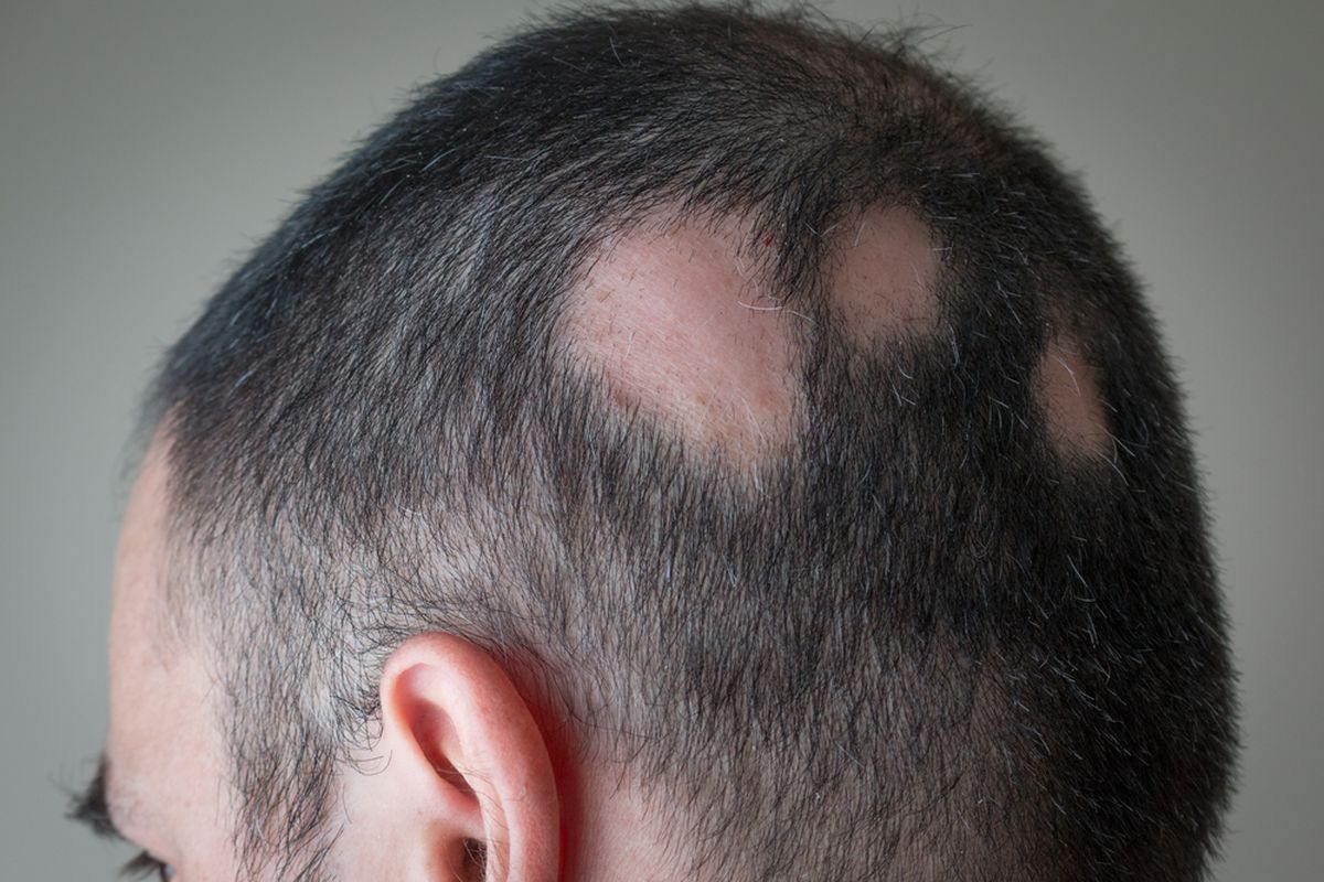 Pemicu Rambut Rontok